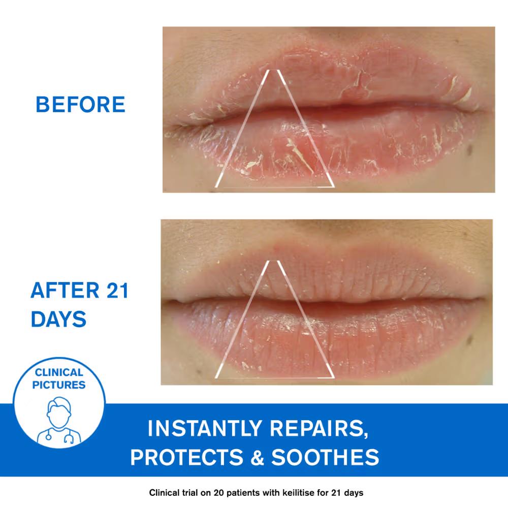 Uriage Bariederm-Cica Protecting Dermat Recommended Lip Balm Repairs Soothes Chapped Damaged Lips, 15ml