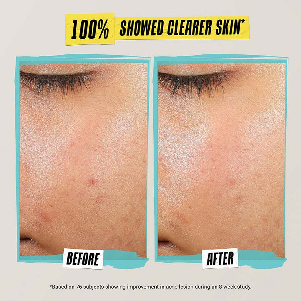 Kiehl's Expertly Clear Blemish-Treating & Preventing Lotion, 60ml