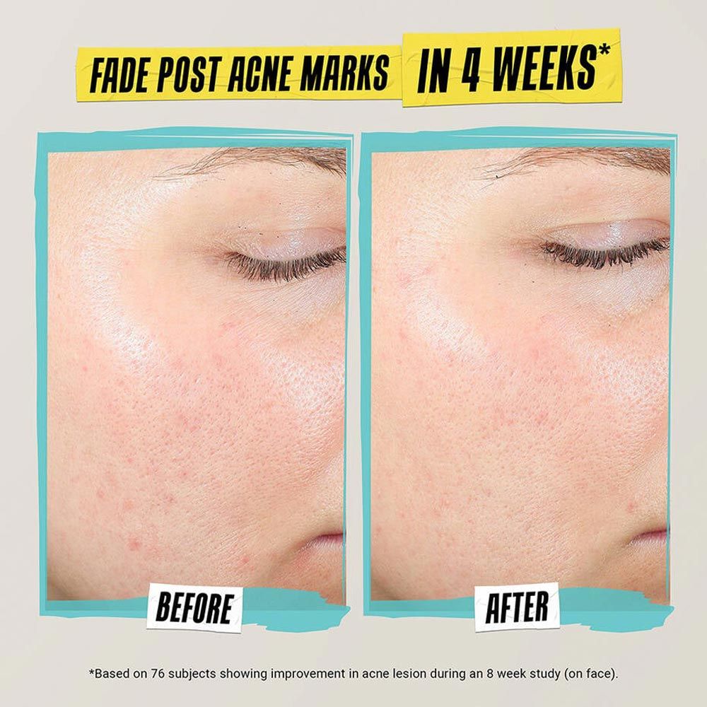 Kiehl's Expertly Clear Blemish-Treating & Preventing Lotion, 60ml